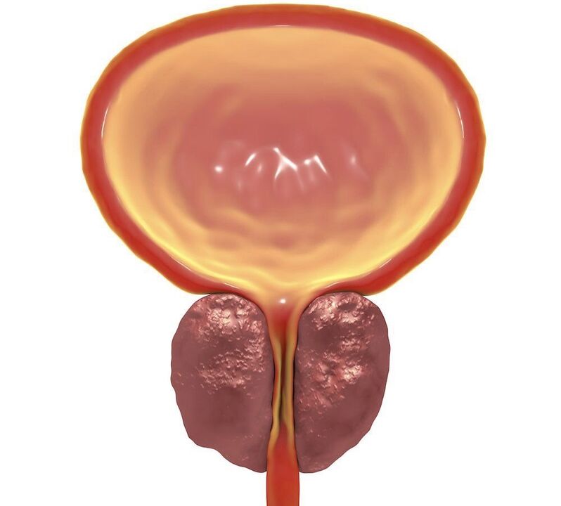 lėtinio prostatito uždegimas