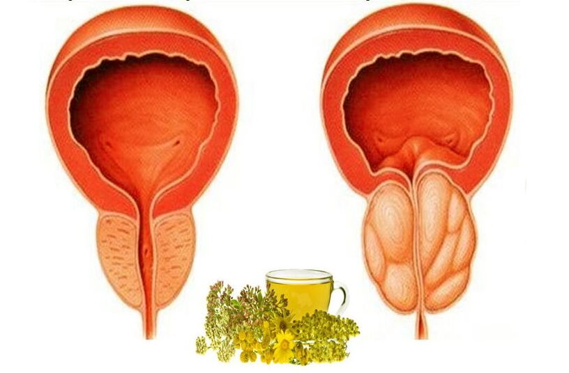 Sveika ir skauda prostatą