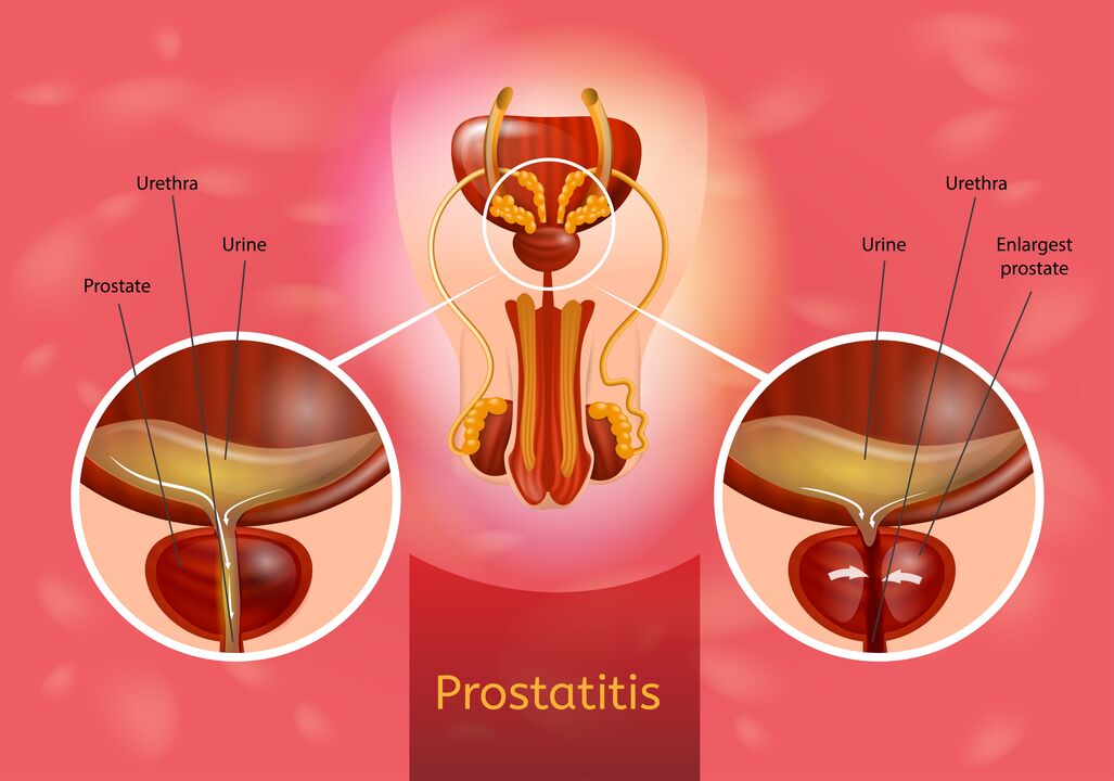 Prostatitas