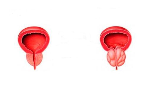 sveika ir uždegusi prostata su prostatitu